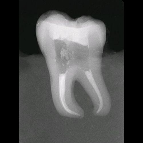 Severely Curved Molar